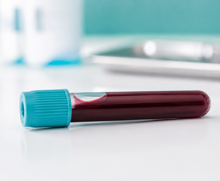 Tubo de análisis de sangre sobre superficie clínica blanca, representando el diagnóstico de triglicéridos altos mediante analítica